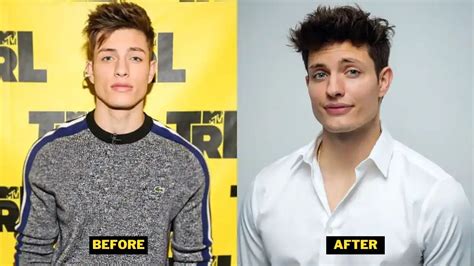 matt rife before and after plastic surgery|Matt Rife Says Delayed Puberty Is Reason for Face Change, Not。